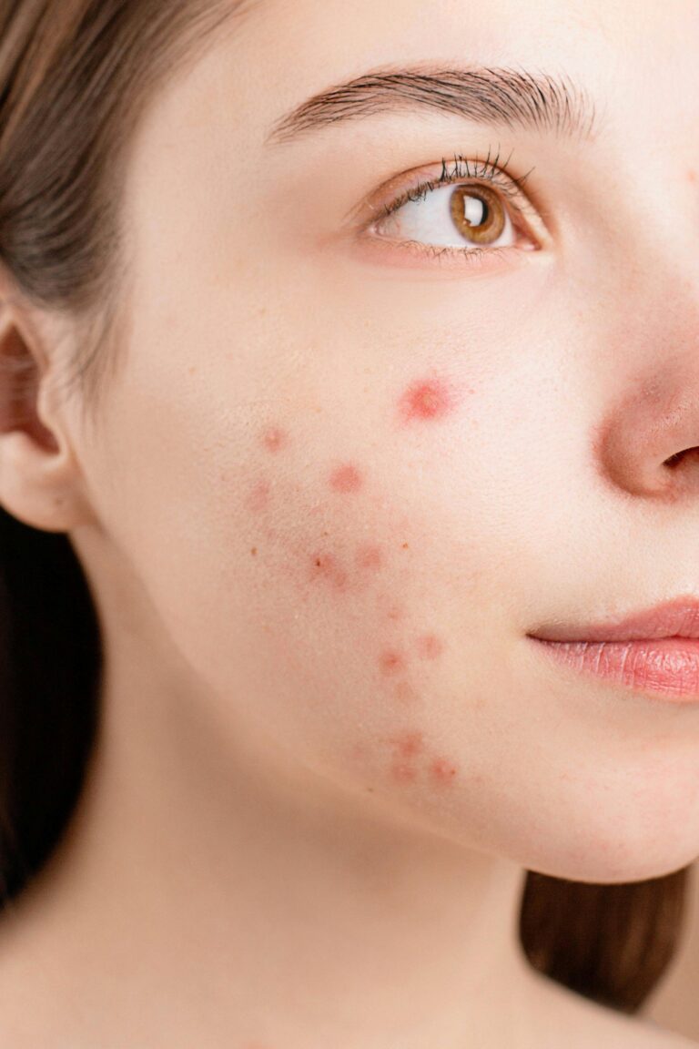 Approach to Acne