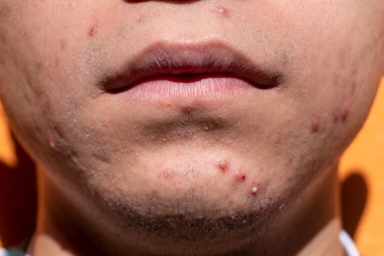 Understanding Acne